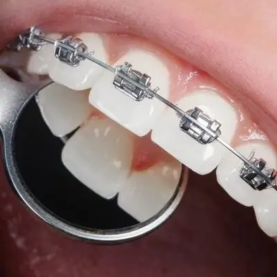 Orthodontic treatments