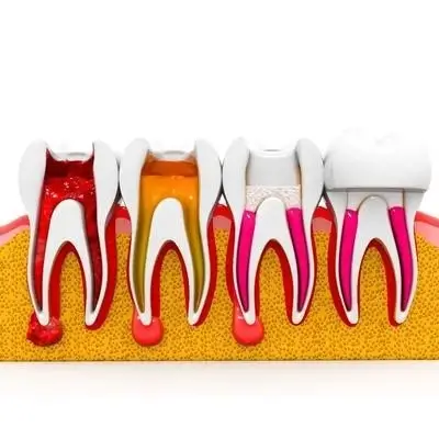 Root canal treatment