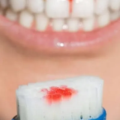 Bleeding gums