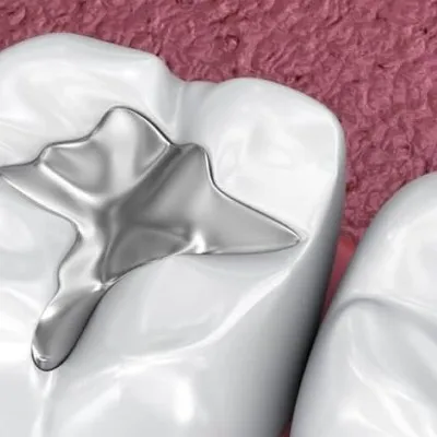 Dental amalgam fillings