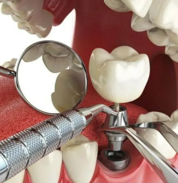 Dental implant