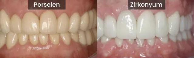 Zirconium porcelain difference