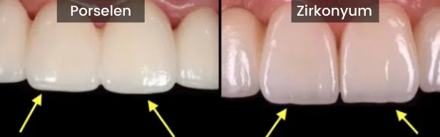 Zirconium porcelain difference