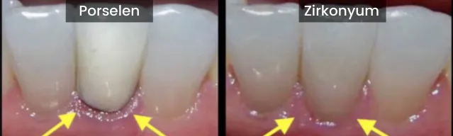 Zirconium porcelain difference