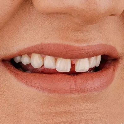 Gapped teeth how we close gaps between teeth