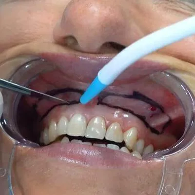 Dental lip repositioning