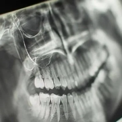 Panoramic Dental X-ray