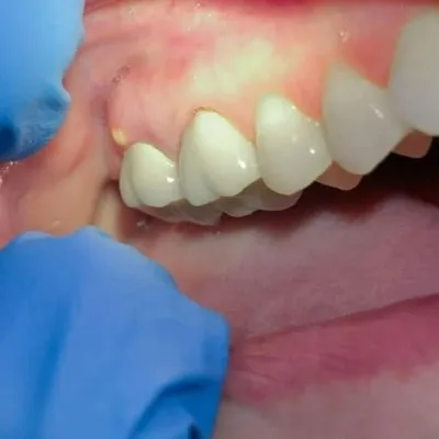 Tooth abscess