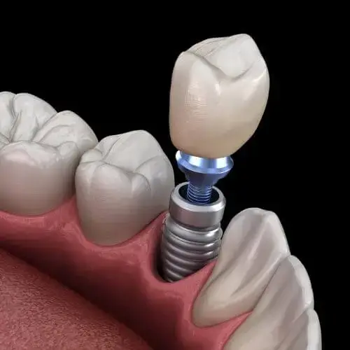 dental implant turkey